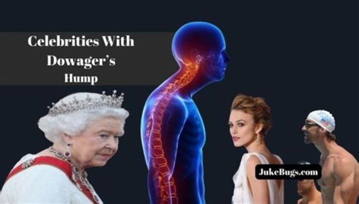 Celebrities With Dowager's Hump